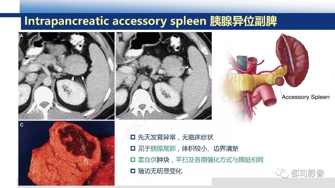 影像PPT - 【病例】胰腺神经内分泌肿瘤肝转移1例CT及MR-33