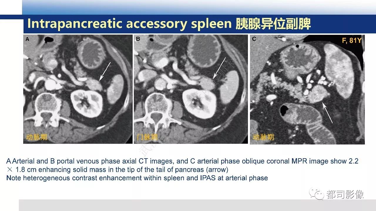 影像PPT - 【病例】胰腺神经内分泌肿瘤肝转移1例CT及MR-34