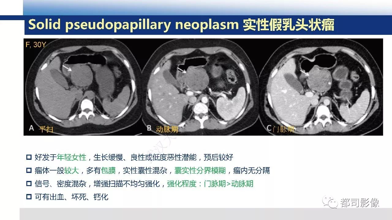 影像PPT - 【病例】胰腺神经内分泌肿瘤肝转移1例CT及MR-35