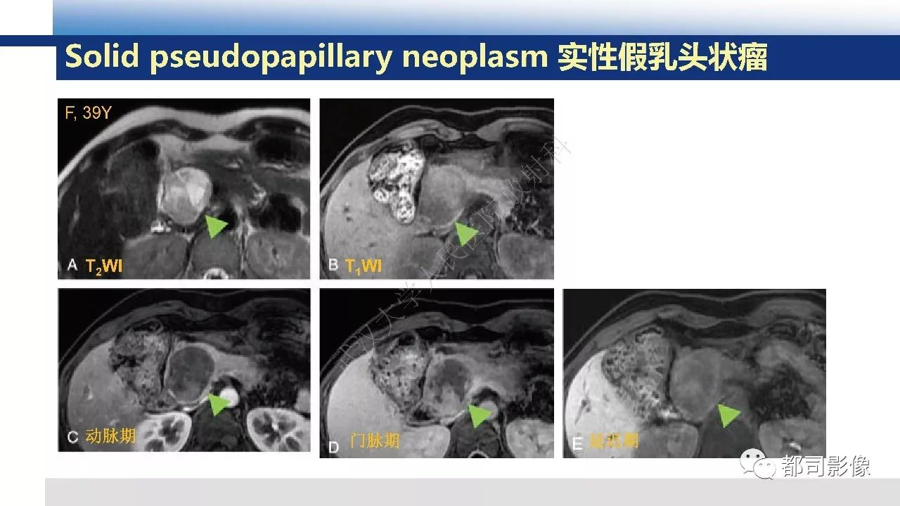 影像PPT - 【病例】胰腺神经内分泌肿瘤肝转移1例CT及MR-36