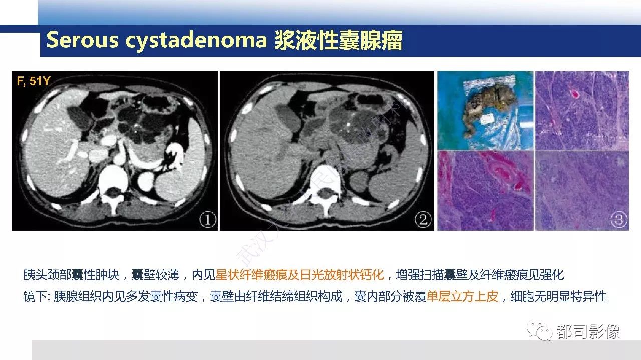 影像PPT - 【病例】胰腺神经内分泌肿瘤肝转移1例CT及MR-38