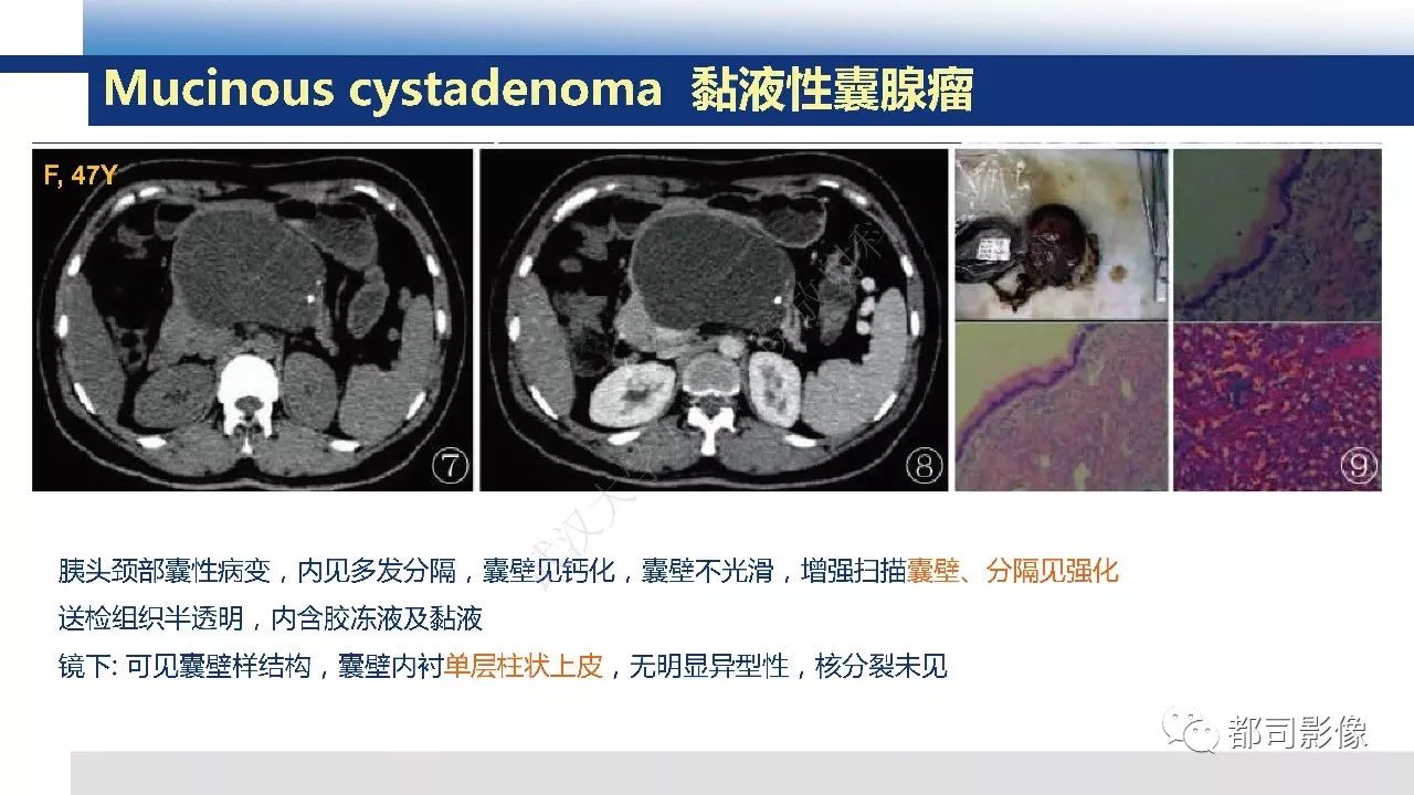 影像PPT - 【病例】胰腺神经内分泌肿瘤肝转移1例CT及MR-39