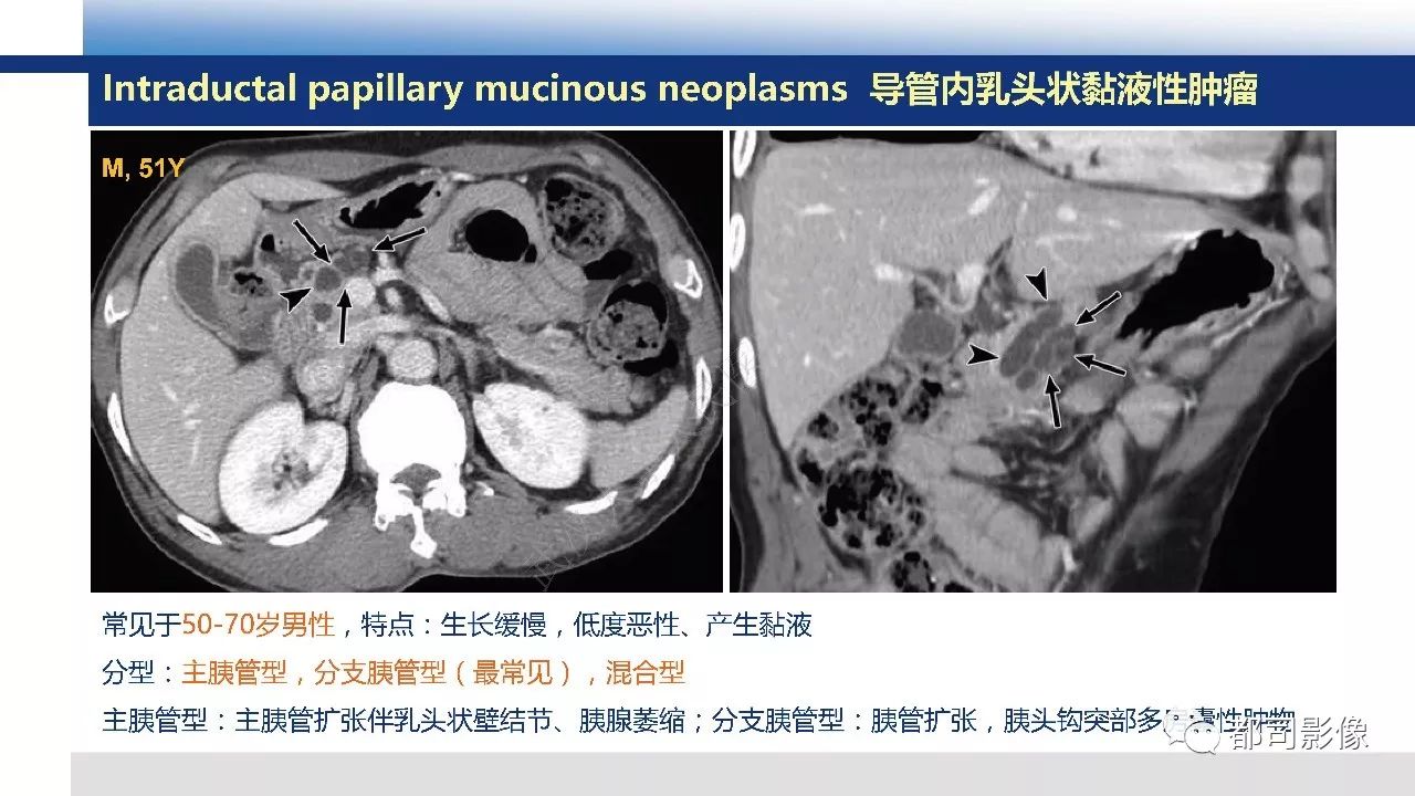 影像PPT - 【病例】胰腺神经内分泌肿瘤肝转移1例CT及MR-40