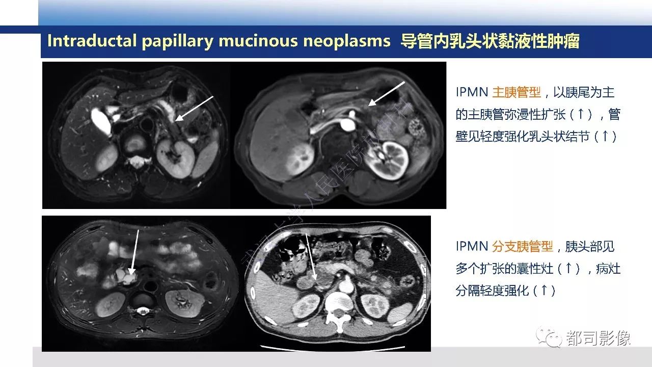 影像PPT - 【病例】胰腺神经内分泌肿瘤肝转移1例CT及MR-41