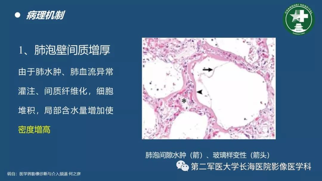 影像PPT - 【PPT】肺磨玻璃影的诊断及鉴别-5