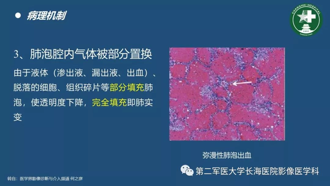 影像PPT - 【PPT】肺磨玻璃影的诊断及鉴别-7