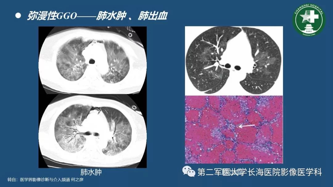 影像PPT - 【PPT】肺磨玻璃影的诊断及鉴别-11