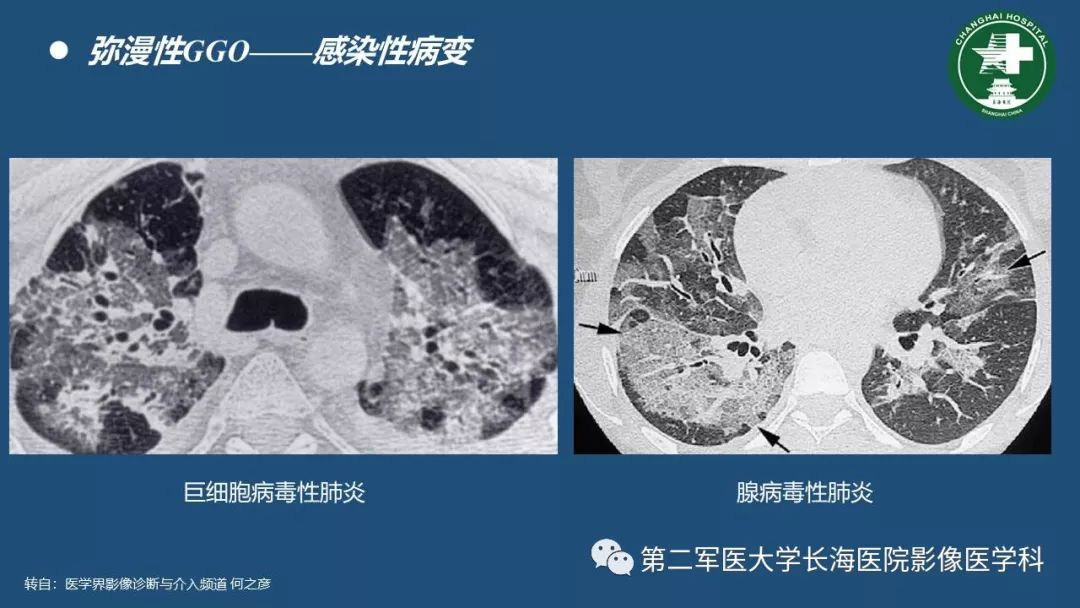 影像PPT - 【PPT】肺磨玻璃影的诊断及鉴别-9