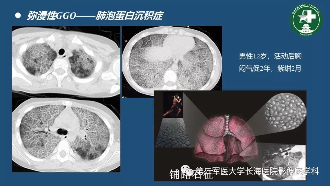 影像PPT - 【PPT】肺磨玻璃影的诊断及鉴别-13