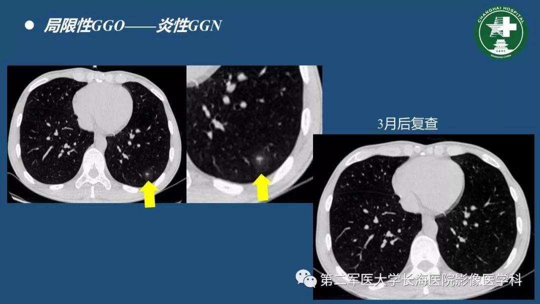 影像PPT - 【PPT】肺磨玻璃影的诊断及鉴别-15