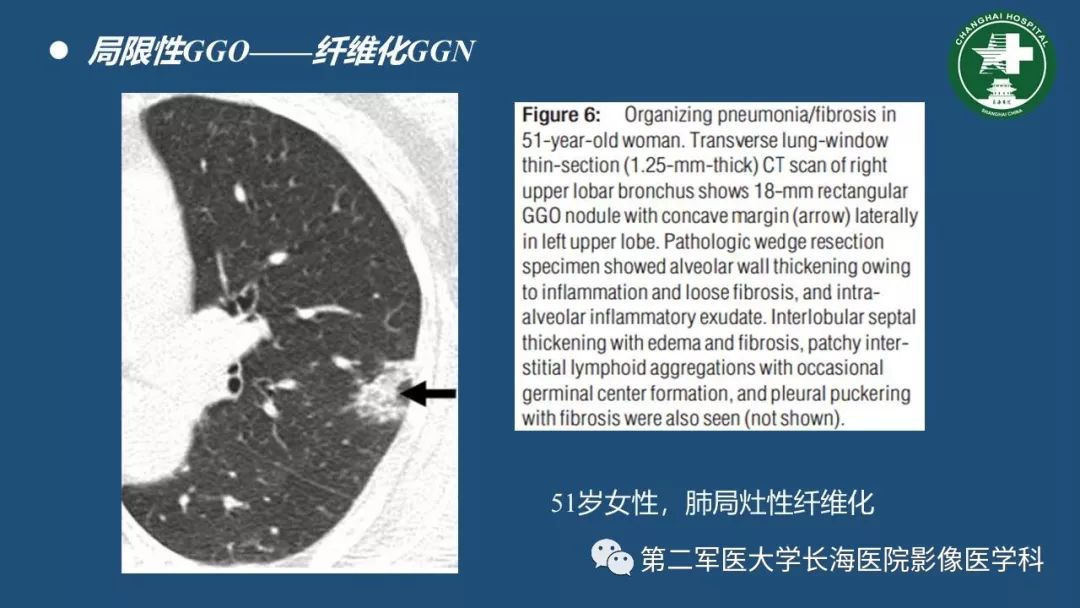 影像PPT - 【PPT】肺磨玻璃影的诊断及鉴别-16