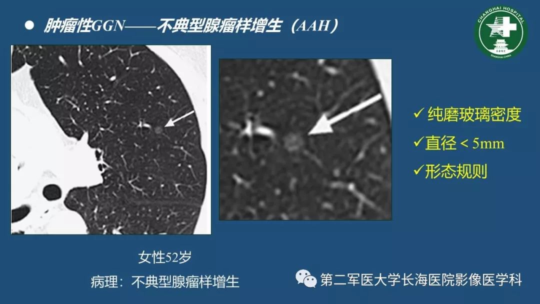 影像PPT - 【PPT】肺磨玻璃影的诊断及鉴别-21