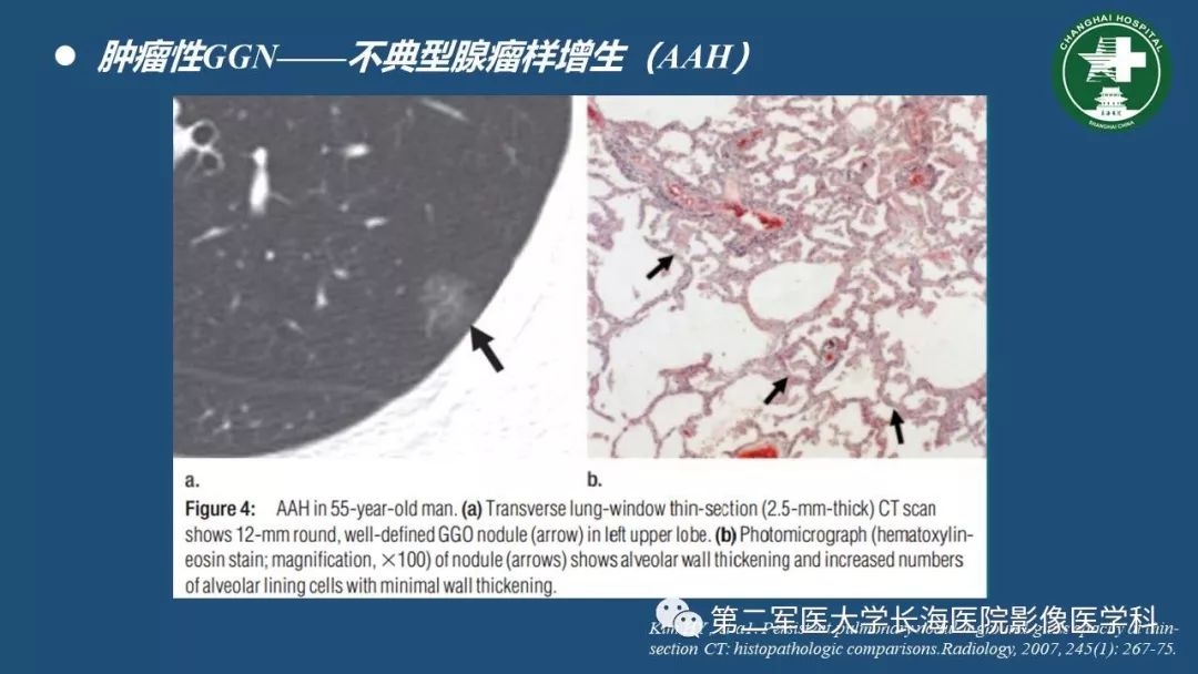 影像PPT - 【PPT】肺磨玻璃影的诊断及鉴别-22