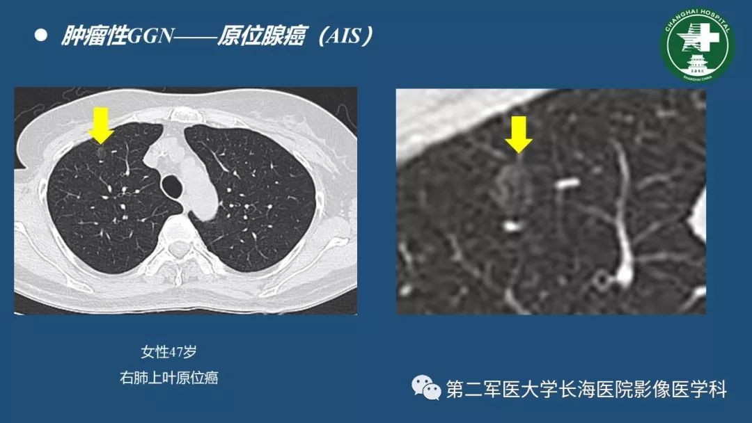 影像PPT - 【PPT】肺磨玻璃影的诊断及鉴别-24