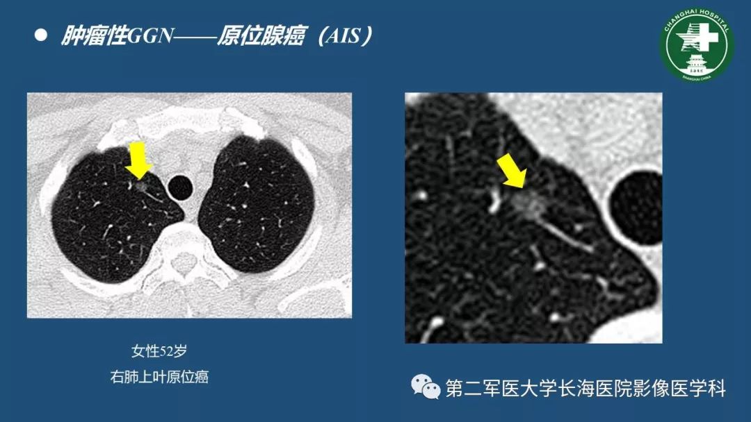 影像PPT - 【PPT】肺磨玻璃影的诊断及鉴别-25