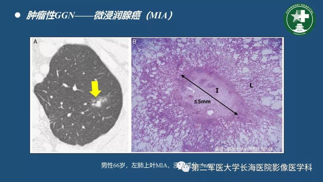 影像PPT - 【PPT】肺磨玻璃影的诊断及鉴别-28
