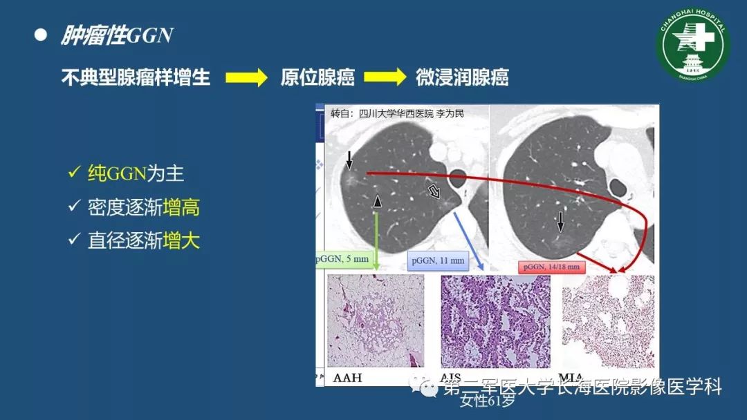 影像PPT - 【PPT】肺磨玻璃影的诊断及鉴别-29