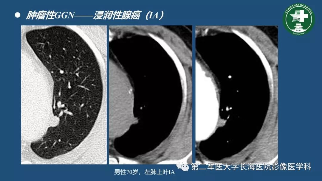 影像PPT - 【PPT】肺磨玻璃影的诊断及鉴别-31