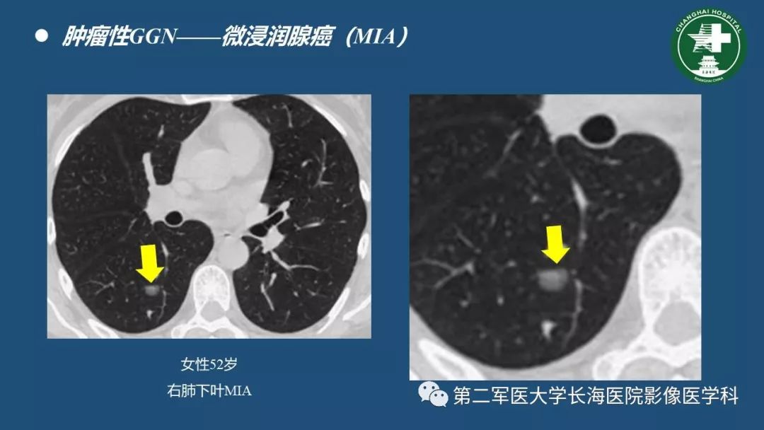 影像PPT - 【PPT】肺磨玻璃影的诊断及鉴别-27