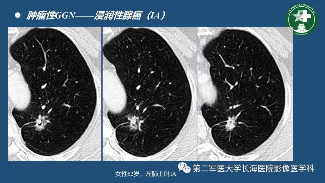 影像PPT - 【PPT】肺磨玻璃影的诊断及鉴别-32