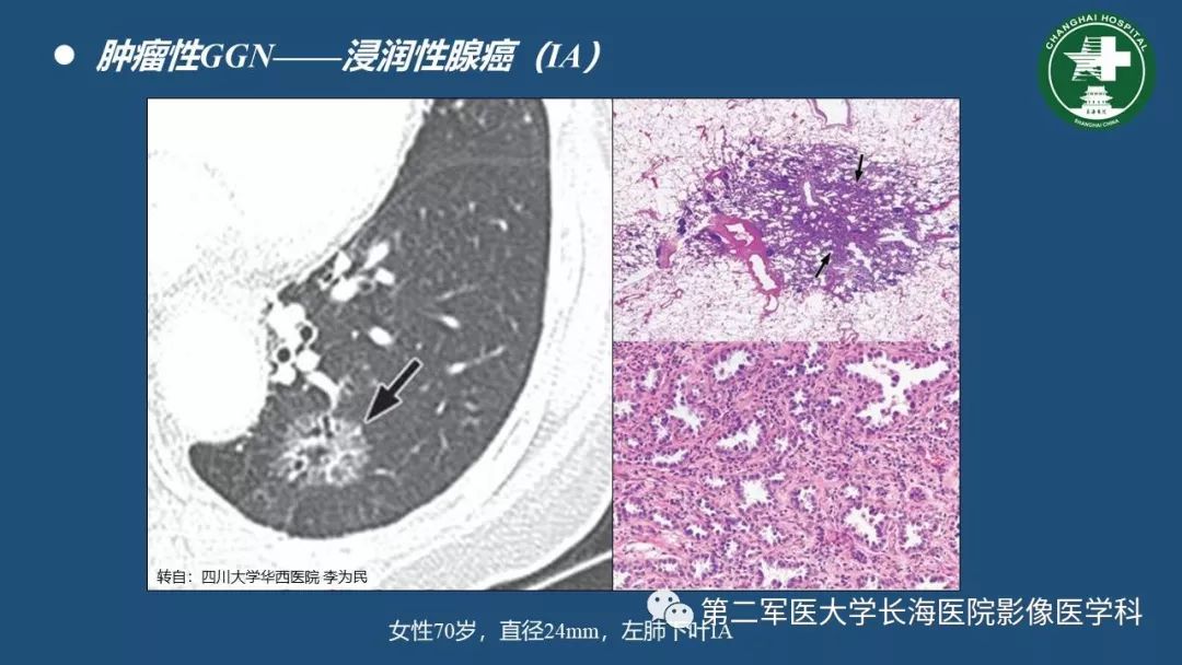 影像PPT - 【PPT】肺磨玻璃影的诊断及鉴别-33