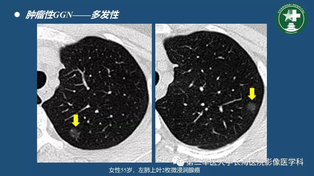 影像PPT - 【PPT】肺磨玻璃影的诊断及鉴别-35