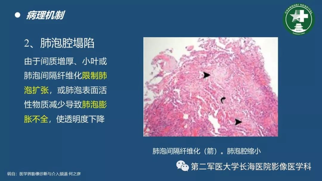影像PPT - 【PPT】肺磨玻璃影的诊断及鉴别-1