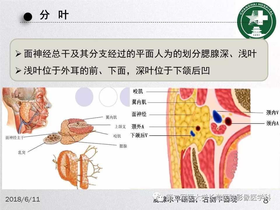 影像PPT - 【PPT】腮腺常见疾病-8