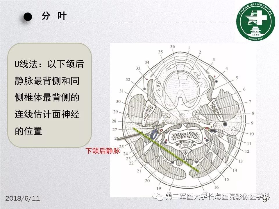 影像PPT - 【PPT】腮腺常见疾病-9