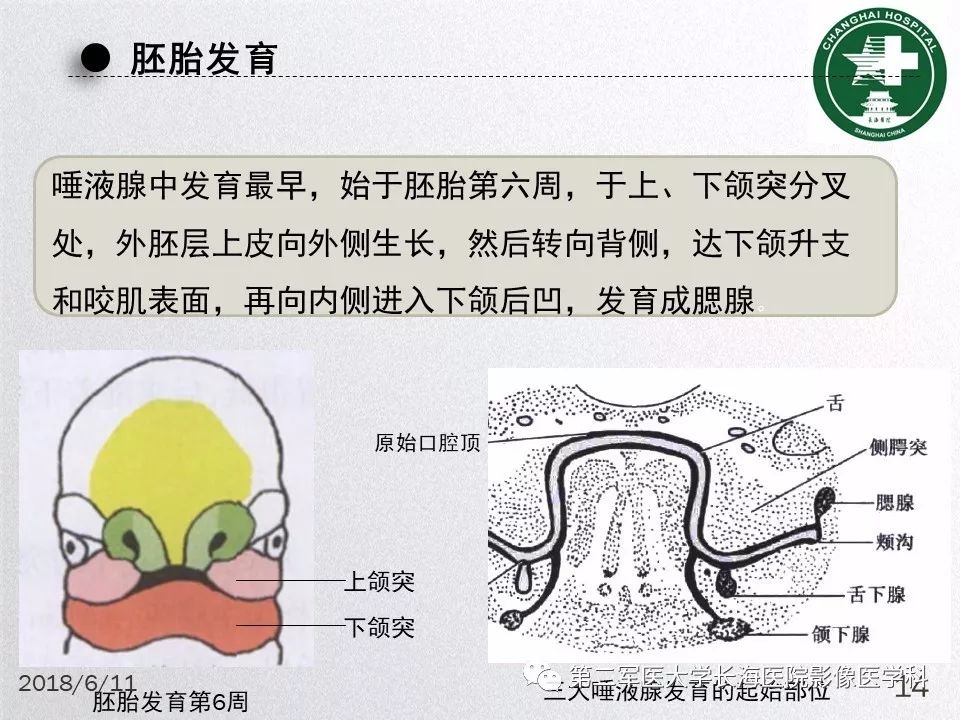影像PPT - 【PPT】腮腺常见疾病-14