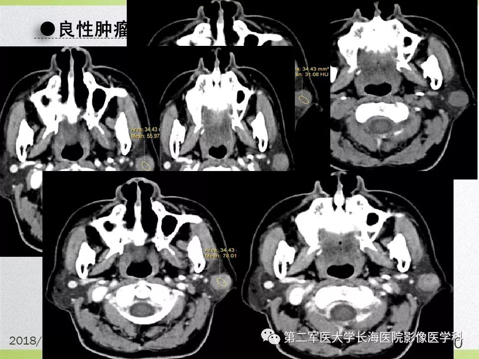 影像PPT - 【PPT】腮腺常见疾病-20