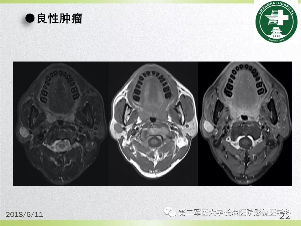 影像PPT - 【PPT】腮腺常见疾病-22