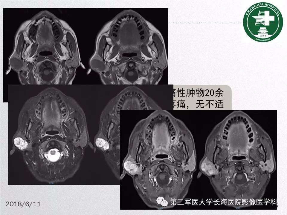 影像PPT - 【PPT】腮腺常见疾病-23