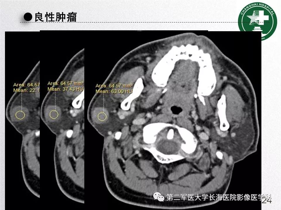 影像PPT - 【PPT】腮腺常见疾病-24