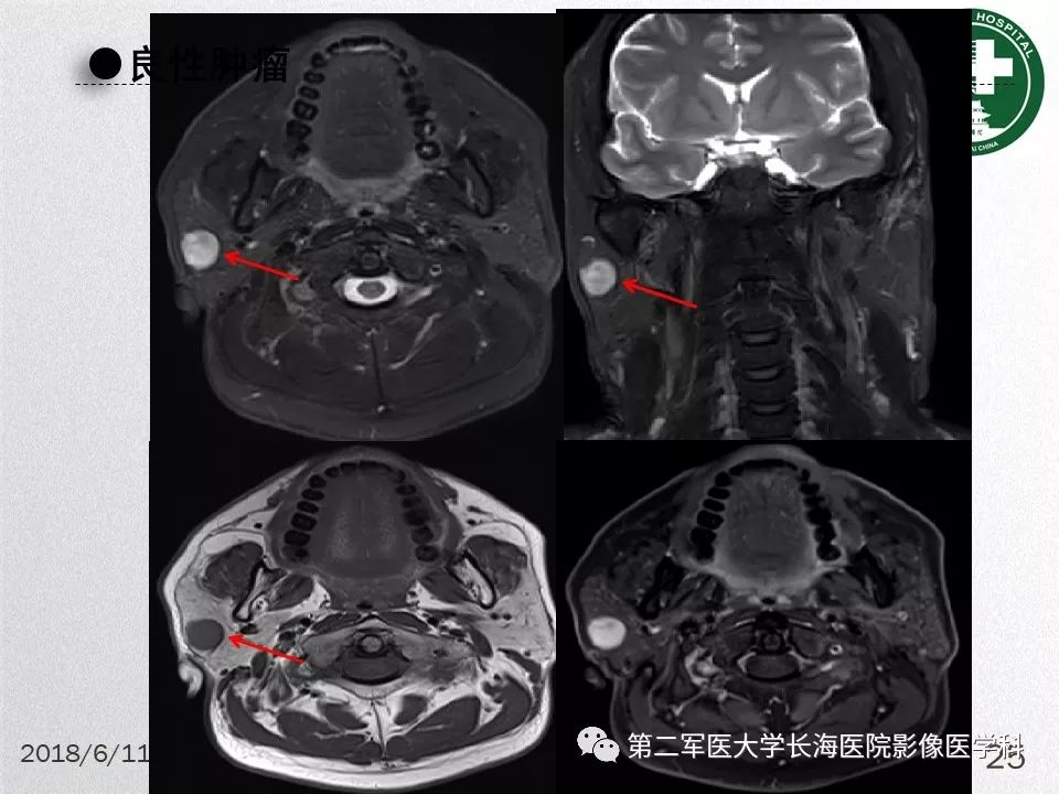 影像PPT - 【PPT】腮腺常见疾病-25