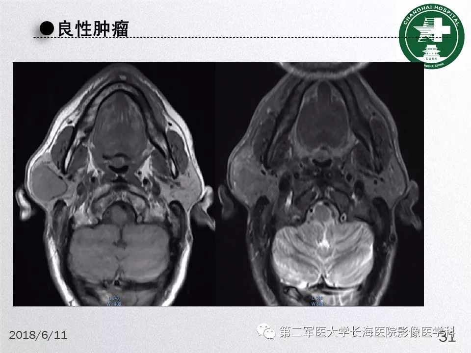 影像PPT - 【PPT】腮腺常见疾病-31