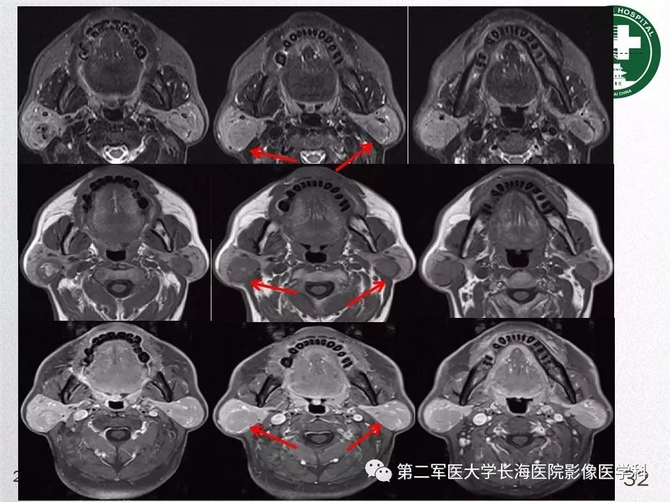 影像PPT - 【PPT】腮腺常见疾病-32