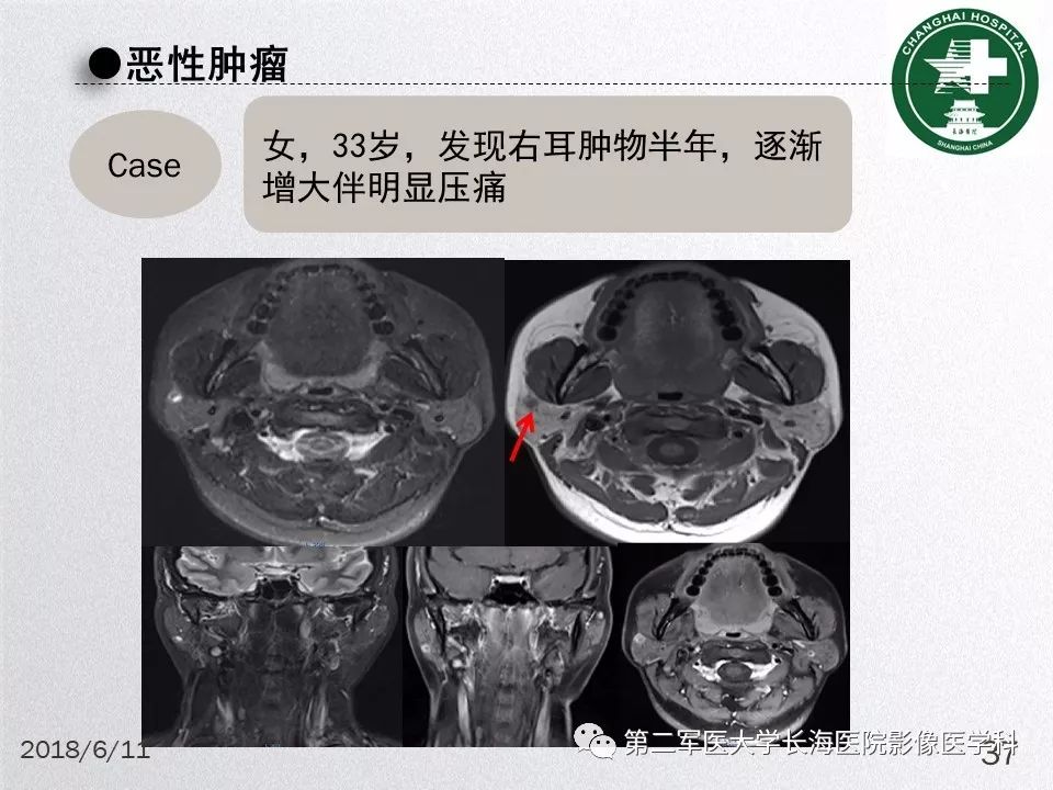 影像PPT - 【PPT】腮腺常见疾病-37