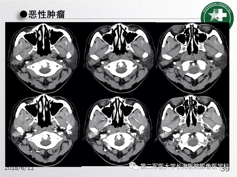 影像PPT - 【PPT】腮腺常见疾病-39