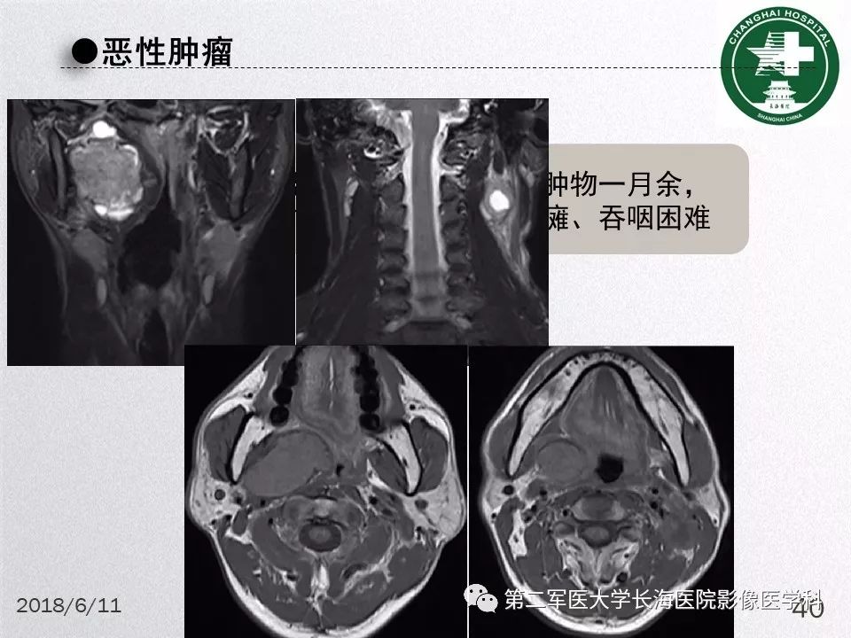 影像PPT - 【PPT】腮腺常见疾病-40