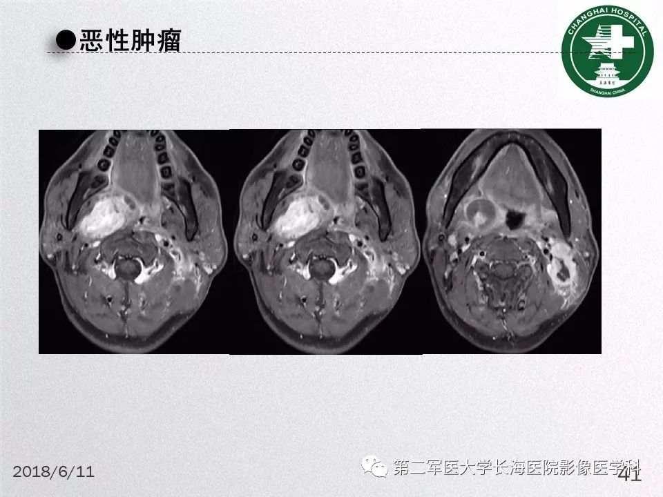 影像PPT - 【PPT】腮腺常见疾病-41
