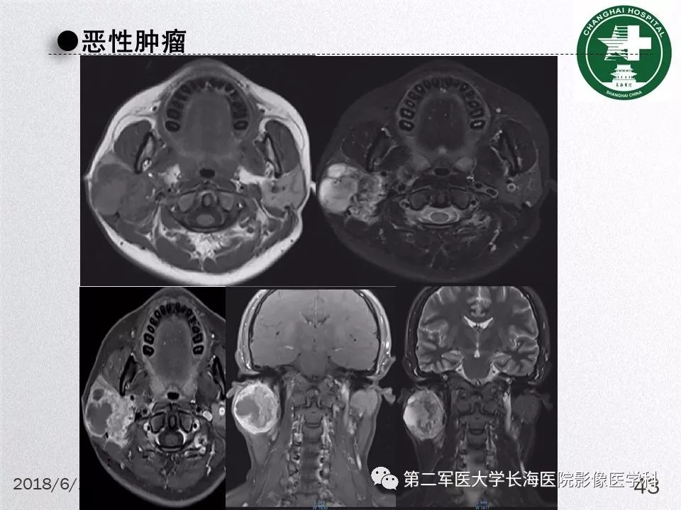 影像PPT - 【PPT】腮腺常见疾病-43