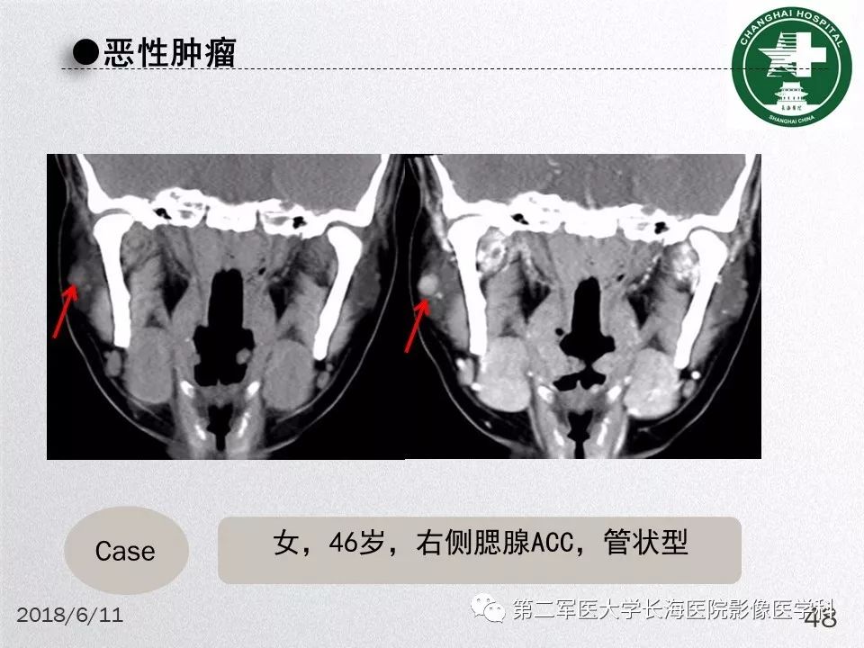 影像PPT - 【PPT】腮腺常见疾病-48