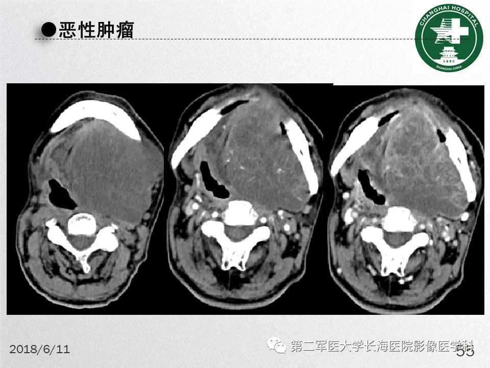 影像PPT - 【PPT】腮腺常见疾病-55