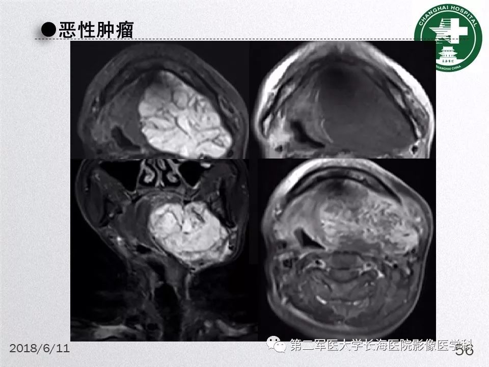 影像PPT - 【PPT】腮腺常见疾病-56