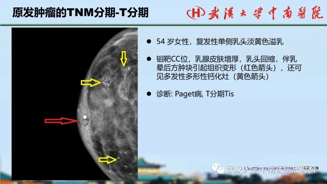 影像PPT - 【PPT】乳腺癌第八版TNM分期解读—影像科医生的责任和挑战-13