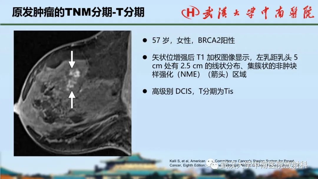 影像PPT - 【PPT】乳腺癌第八版TNM分期解读—影像科医生的责任和挑战-12