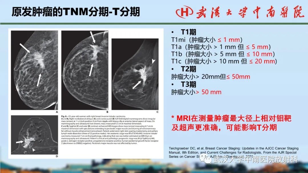 影像PPT - 【PPT】乳腺癌第八版TNM分期解读—影像科医生的责任和挑战-15