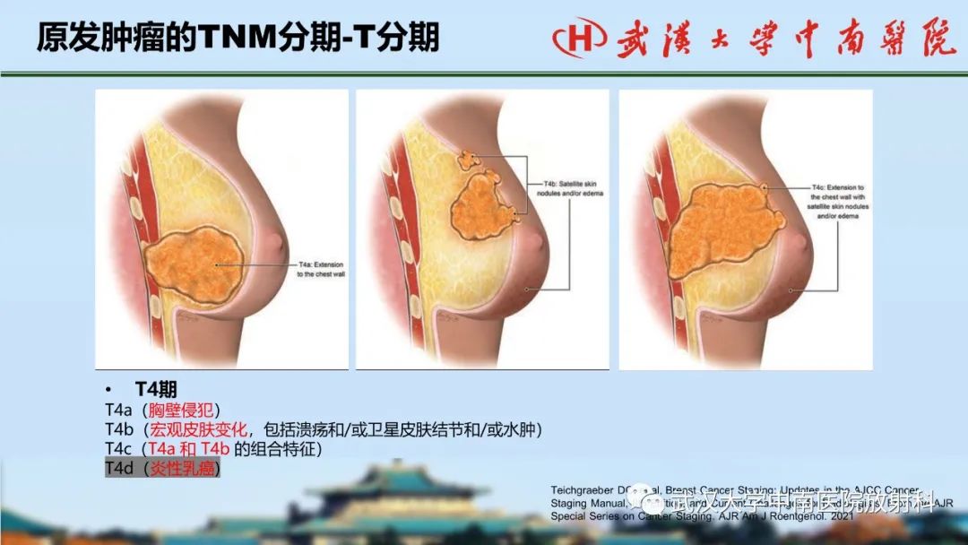影像PPT - 【PPT】乳腺癌第八版TNM分期解读—影像科医生的责任和挑战-18