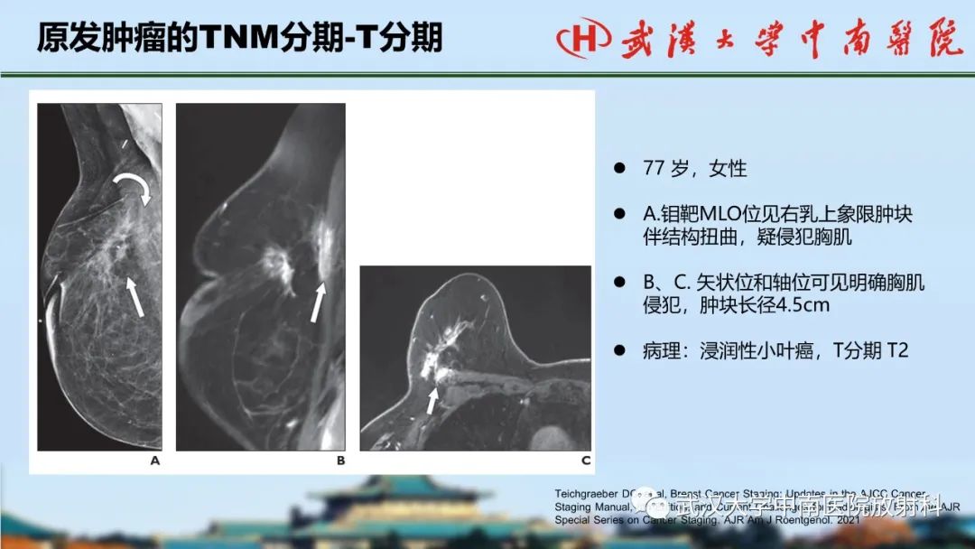 影像PPT - 【PPT】乳腺癌第八版TNM分期解读—影像科医生的责任和挑战-21
